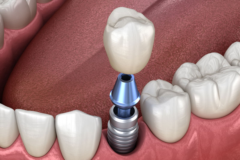 Single Dental Implant Model In A Patient's Gum