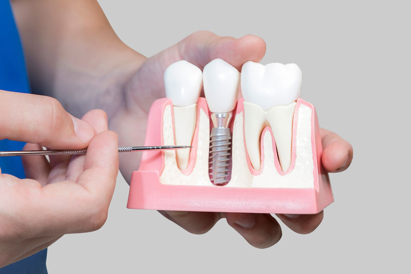 Dental Implant With Bone Cutaway Showing Implant Post Model
