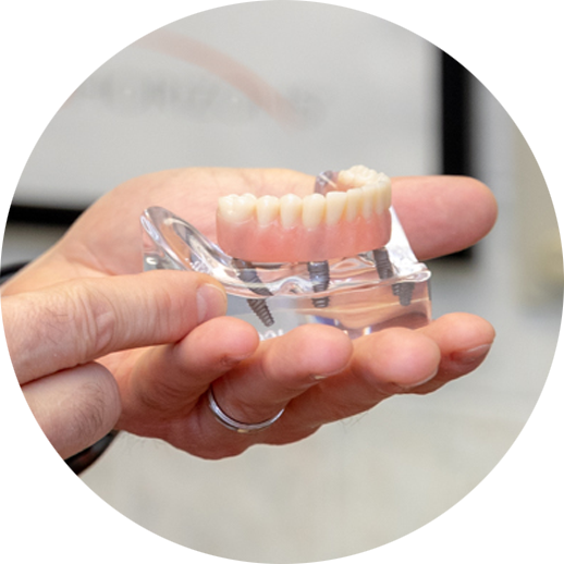 All On 4 Full Mouth Dental Implant Model