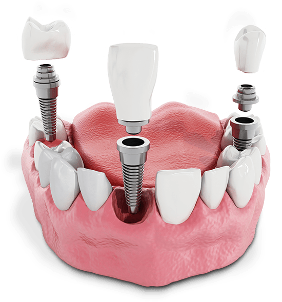 Multiple Dental Implants In A Patient's Mouth