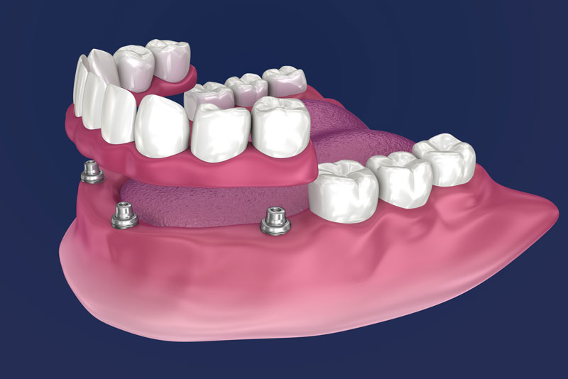 Partial Dentures On Dental Implants Graphic