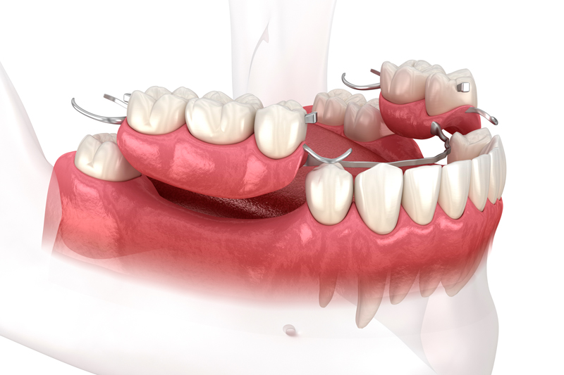 Close-up 3d model of a dental implant