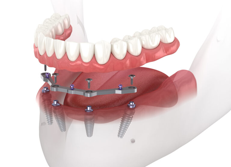 Mandibular prosthesis with gum All on 4 system supported by implants. Medically accurate 3D illustration.