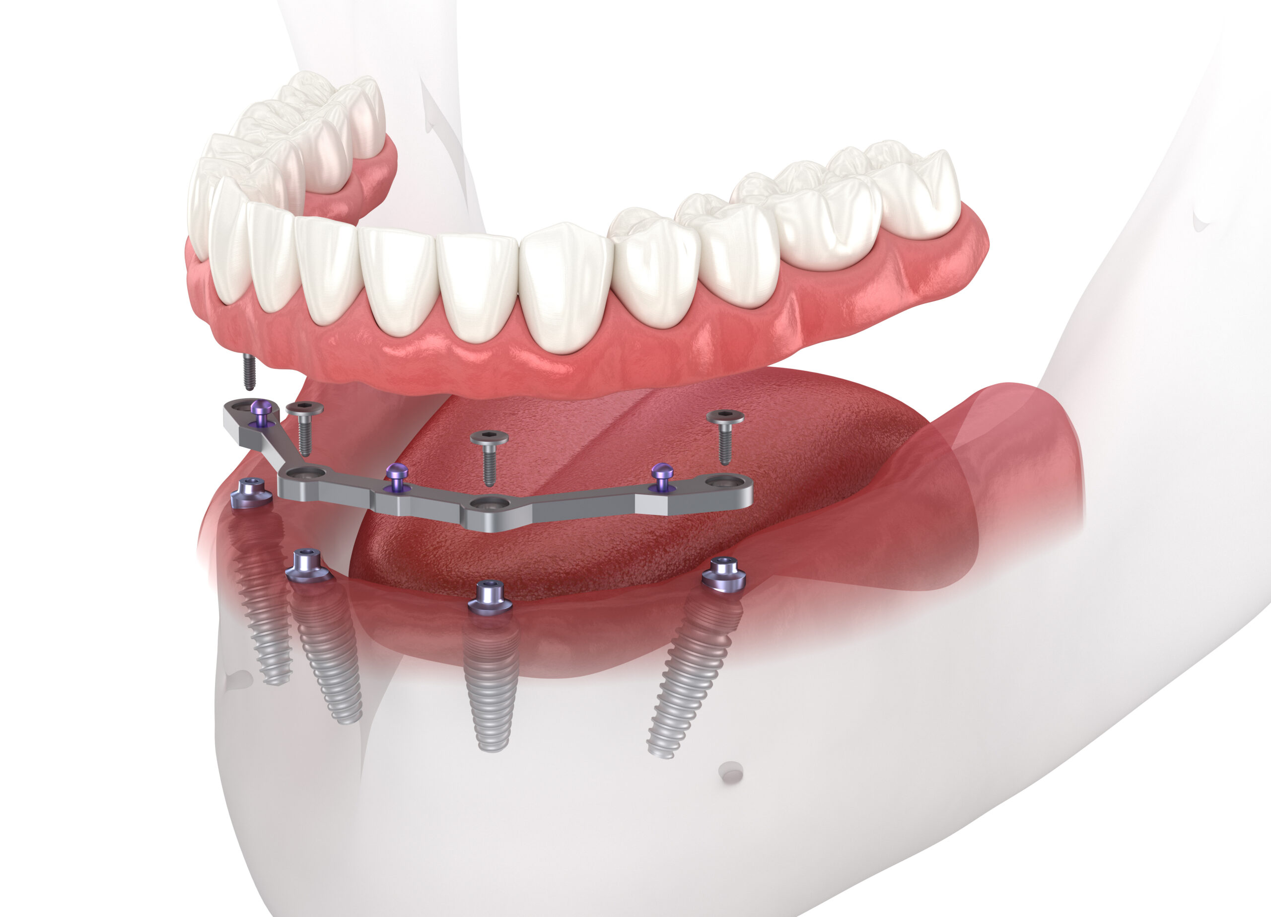 Mandibular prosthesis with gum All on 4 system supported by implants. Medically accurate 3D illustration.