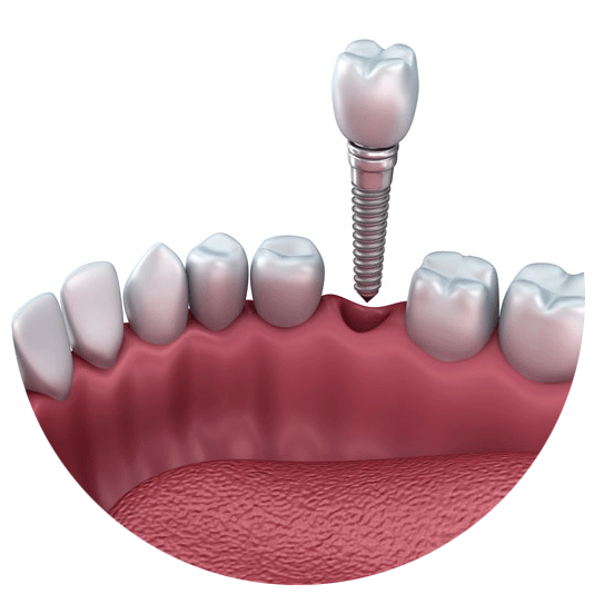 Dental Implant Options All On 4 Full Mouth Implants Shelbyville, KY