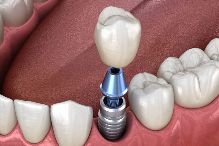 dental implant model.