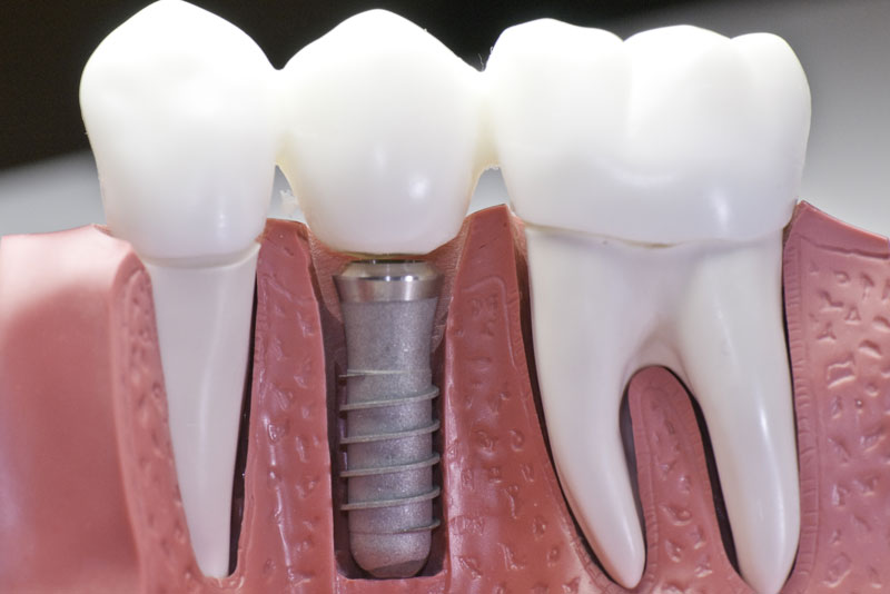 dental implant model.