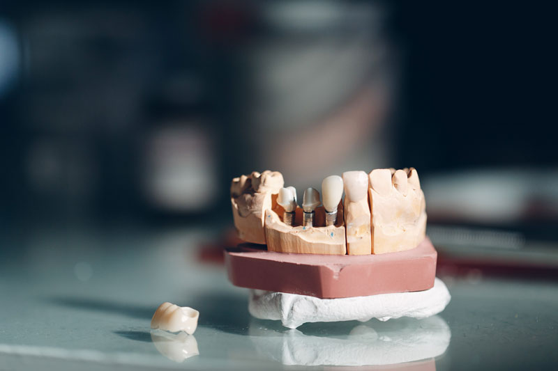 Dental layout of the human jaw with teeth and implants