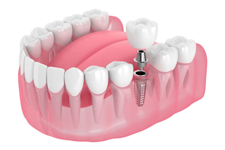 single dental implant 3d model image with a white background