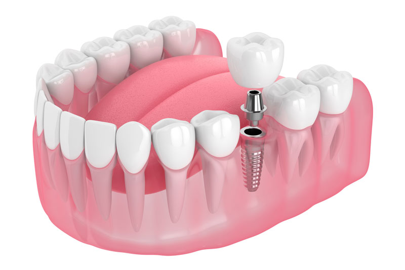 single dental implant 3d model image with a white background