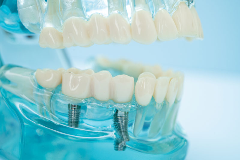 full mouth dental implants model, blue implant solutions
