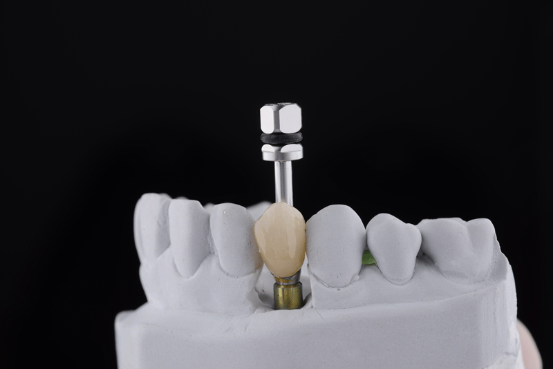 single-implant-model-with-black-background