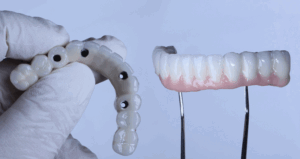 Full arch porcelain dental prosthesis on only 4 implants for completely edentulous jaws in dental jaw surgery and dentistry