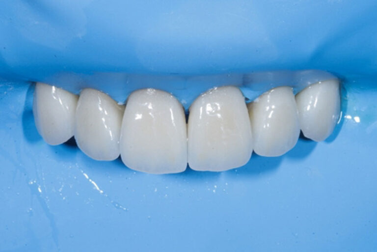 Close-up of dental crowns on upper front teeth with rubber dam isolation during a restorative dental procedure.