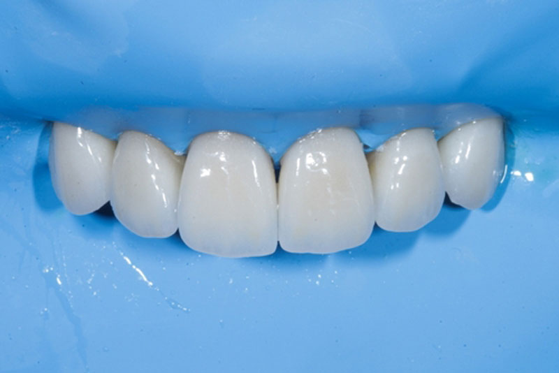 Close-up of dental crowns on upper front teeth with rubber dam isolation during a restorative dental procedure.