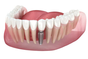 3d image model of a dental jaw model with a dental implant, white background