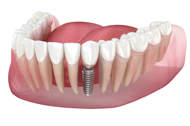 3d image model of a dental jaw model with a dental implant, white background