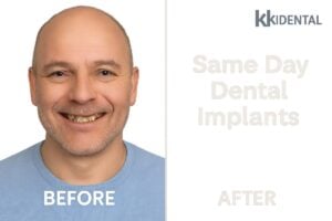 An image of a smiling patient, with the kk dental logo in the top corner, showcasing a before and after smile transformation thanks to dental implants. Text on the image says "Same Day Dental Implants".