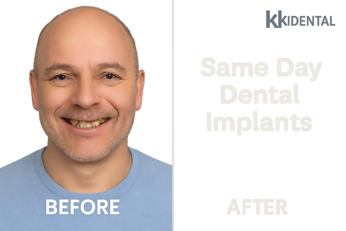 An image of a smiling patient, with the kk dental logo in the top corner, showcasing a before and after smile transformation thanks to dental implants. Text on the image says "Same Day Dental Implants".